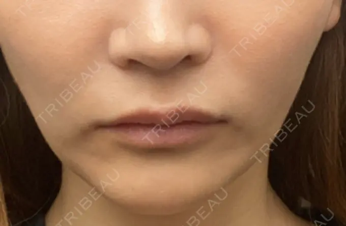 ヒアルロン酸注入（鼻翼基部） THE FIRST CLINIC 町田院 BEFORE メイン用