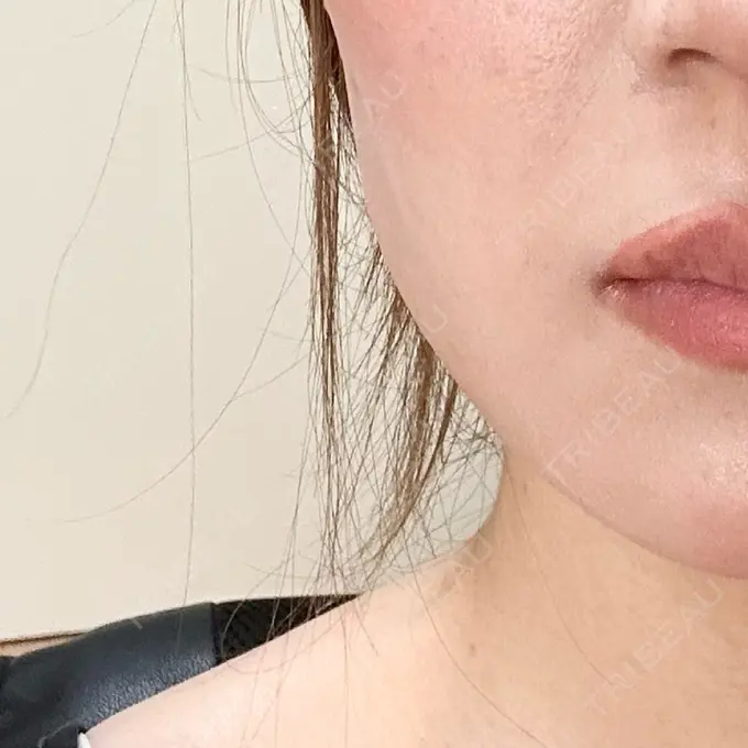 ボトックス（エラ・小顔） 共立美容外科 立川院 BEFORE メイン用