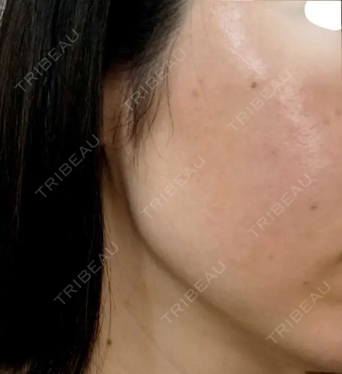 光治療（フォトフェイシャルなど） B-leafメディカル内科小児科クリニック BEFORE メイン用