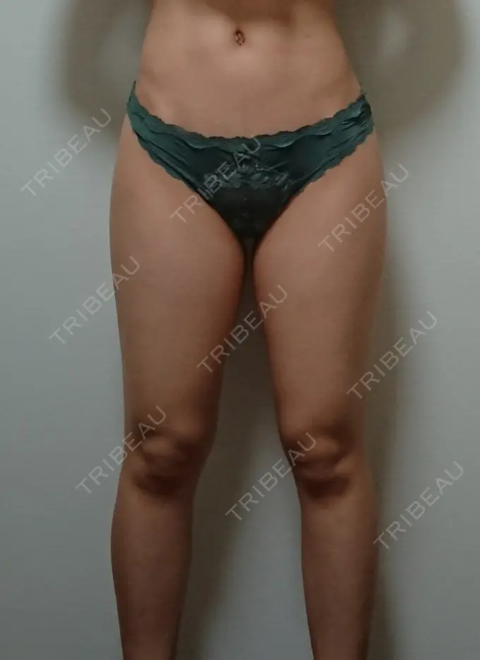 脂肪吸引（脚） THE CLINIC（ザ・クリニック） 名古屋院 BEFORE メイン用