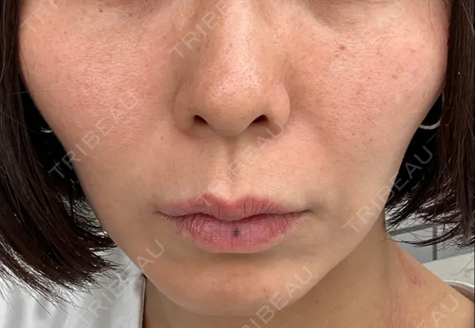 RF（高周波）たるみ治療 東京美容医療クリニック 池袋院 BEFORE メイン用