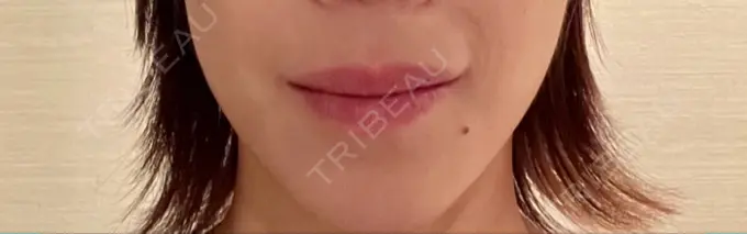 アートメイク（唇） THE ARTMAKE TOKYO 銀座院 BEFORE メイン用