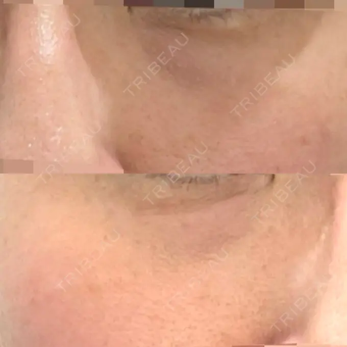 リジュラン 湘南美容クリニック 新宿南口院 BEFORE メイン用