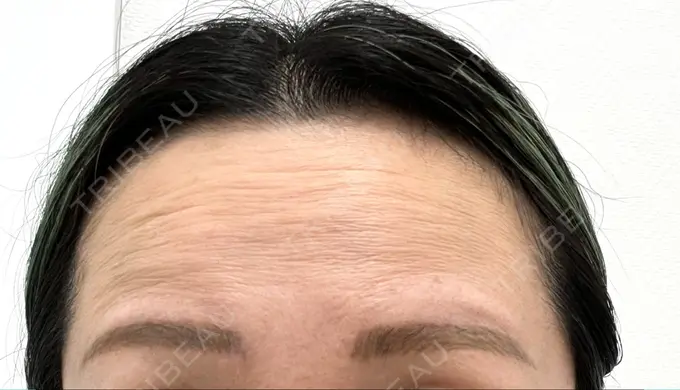 ボトックス（エラ・小顔） / ボトックス（眉間） / ボトックス（目尻） / ボトックス（額） 川越TAクリニックアソシエ BEFORE メイン用