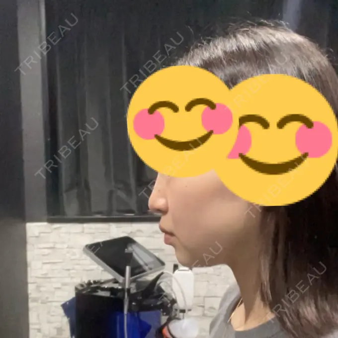 RF（高周波）たるみ治療 ライブリークリニック 浜松町院 BEFORE メイン用