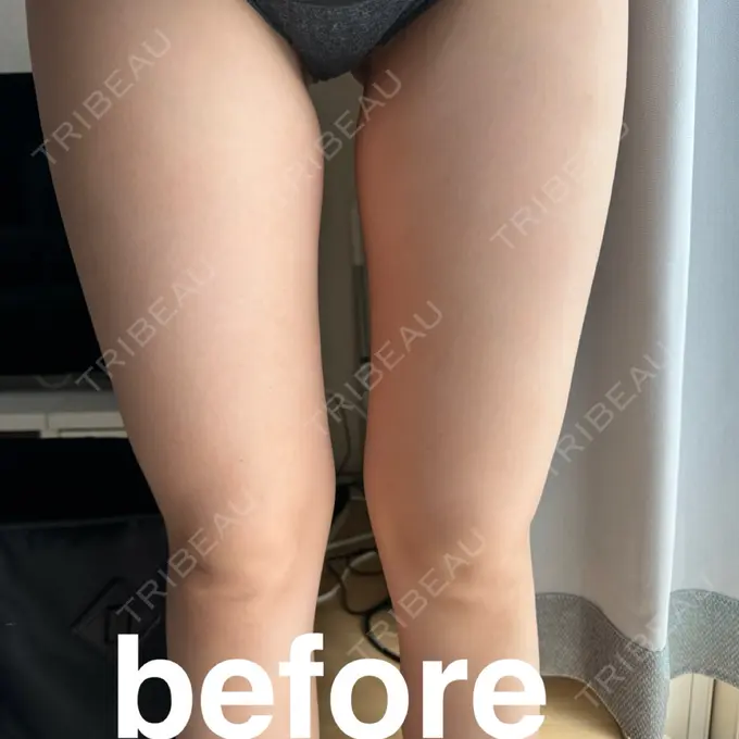 脂肪吸引（脚） / 医療痩身（太もも） Mods Clinic（モッズクリニック） 大阪院 BEFORE メイン用