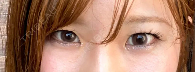 二重埋没 / 脂肪溶解注射（顔） / ボトックス（眉間） / ボトックス（額） / その他（鼻） X CLINIC 恵比寿院 BEFORE メイン用