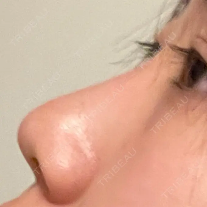 鼻中隔延長（非切開） Brandnew Beauty Clinic BEFORE メイン用