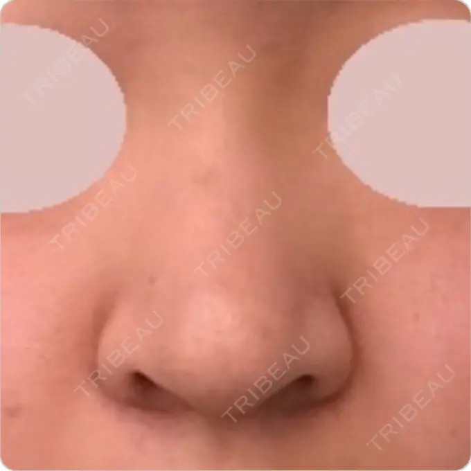 鼻中隔延長（切開） / 小鼻縮小（切開） / 軟骨移植 / 眉間プロテーゼ / 鼻孔縁下降 加美（GAMI）整形外科 BEFORE メイン用