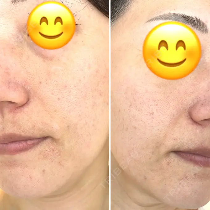 その他（肌） 新宿ラクル美容外科クリニック 新宿院 BEFORE メイン用