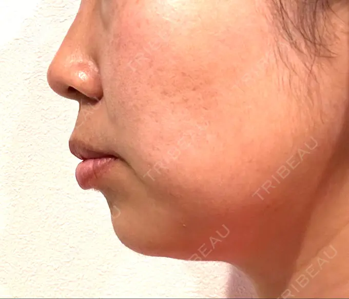 脂肪溶解注射（顔） 表参道ウィズ・クリニック BEFORE メイン用