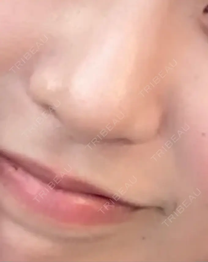 脂肪吸引注射（顔） / その他（鼻） 吉祥寺アイビークリニック BEFORE メイン用