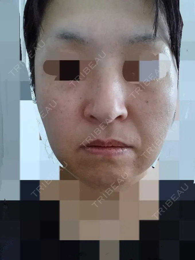 ボトックス（口角） TCB東京中央美容外科 仙台駅前院 BEFORE メイン用