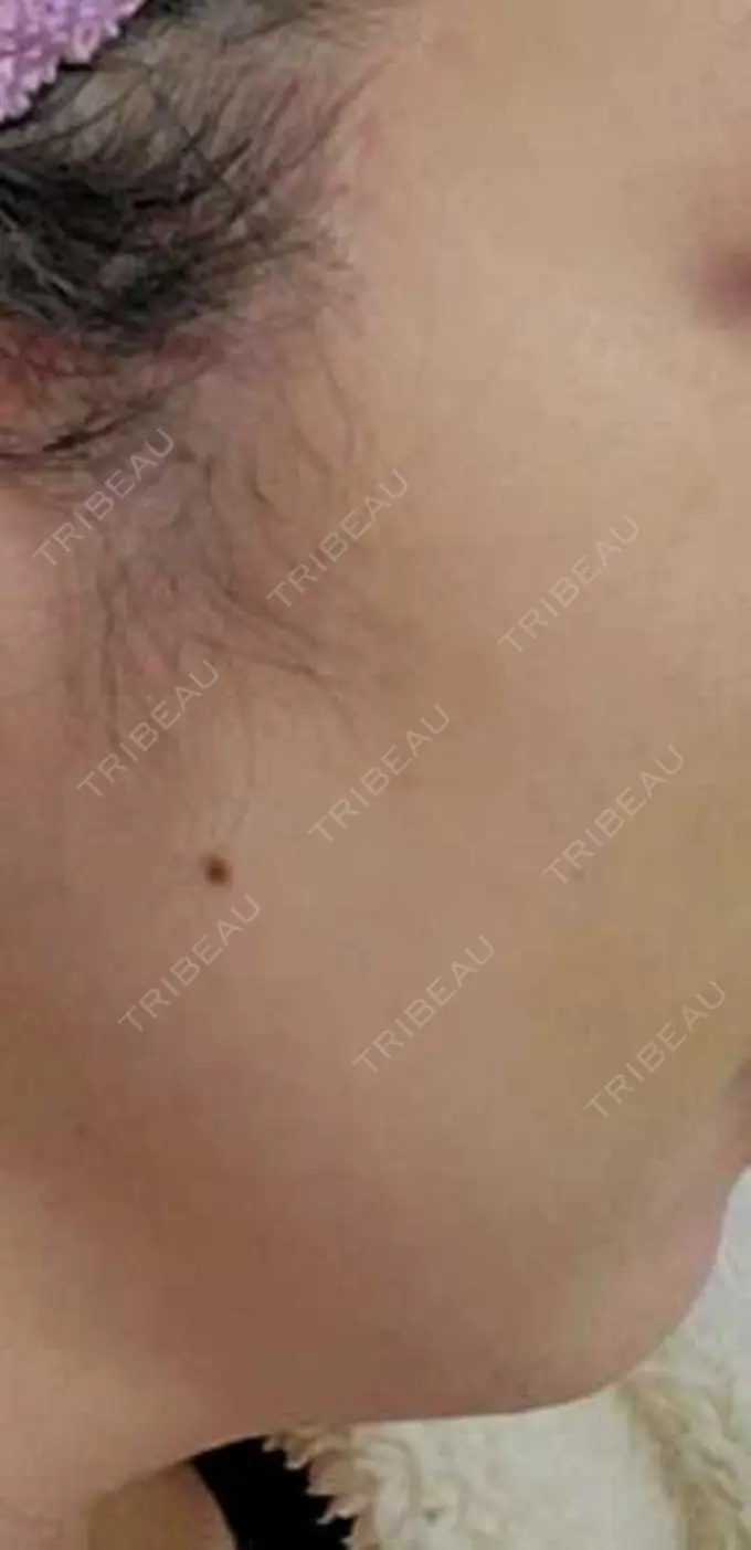 ほくろ・いぼ除去レーザー（肌） Mavie Beauty Clinic （マヴィービューティークリニック） BEFORE メイン用