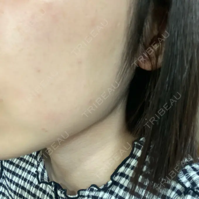 医療脱毛（顔） 共立美容外科 熊本院 BEFORE メイン用