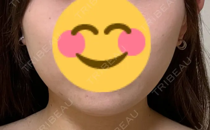 脂肪溶解注射（顔） 表参道ウィズ・クリニック BEFORE メイン用