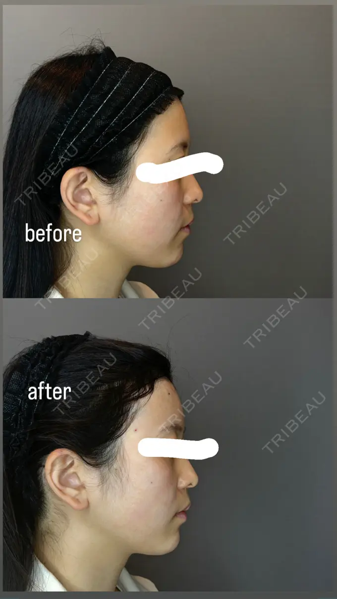 額を丸く / ヒアルロン酸注入（こめかみ） ハナビューティークリニック BEFORE メイン用