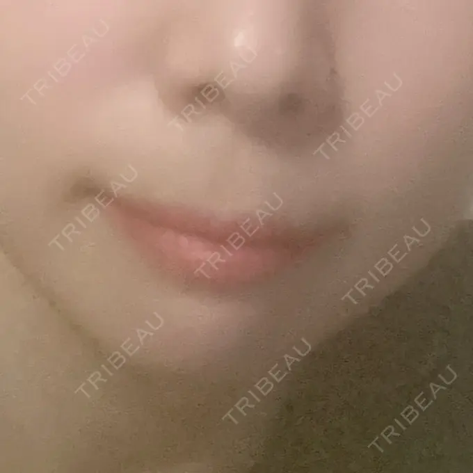 人中短縮 / ボトックス（人中） 新宿ラクル美容外科クリニック 新宿院 BEFORE メイン用