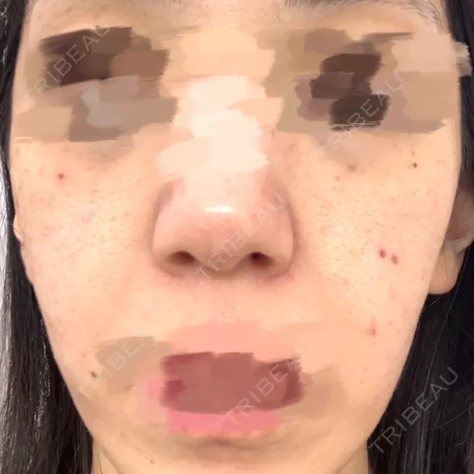 毛穴洗浄（ハイドラフェイシャルなど） 日本美容・医療クリニック 六本木院 BEFORE メイン用