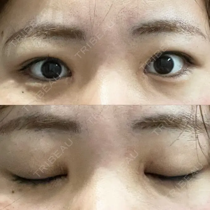 上まぶたの脂肪取り 湘南美容クリニック 大阪なんば院 BEFORE メイン用