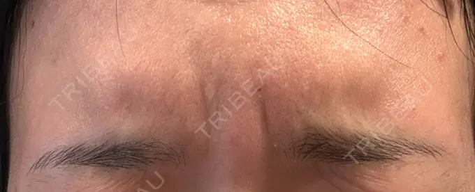 シワ取りボトックス 静岡中央クリニック BEFORE メイン用