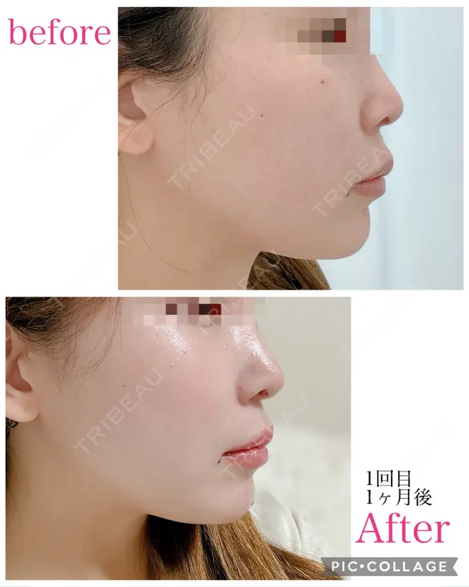 ハイフ（顔） 東京シンデレラ美容外科 大宮院 BEFORE メイン用