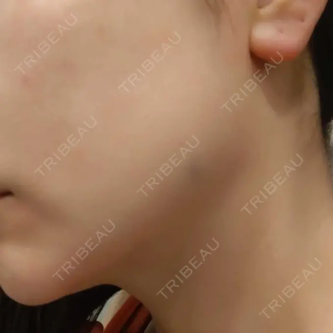 ボトックス（エラ・小顔） / ボトックス（肩） TCB東京中央美容外科 立川院 BEFORE メイン用