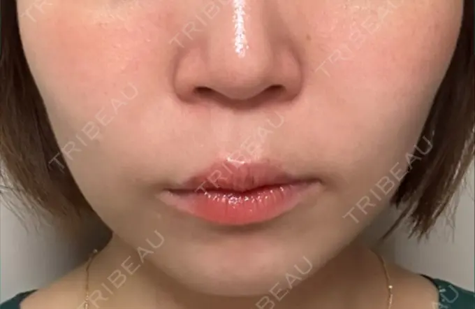 医療痩身（顔） / その他（輪郭） ライブリークリニック 浜松町院 BEFORE メイン用