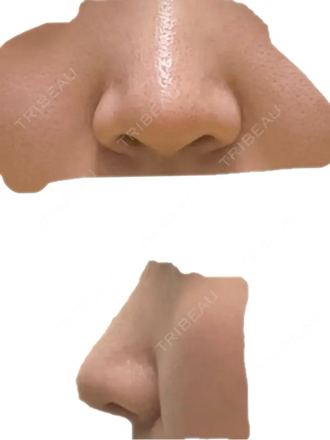 鼻中隔延長（切開） こいずみ形成クリニック名古屋 BEFORE メイン用