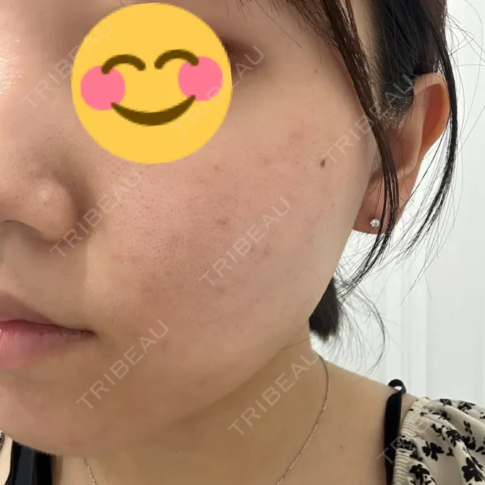 その他（肌） / ピーリング（ニキビ・毛穴） / エレクトロポレーション 新宿美容外科クリニック 新宿院 BEFORE メイン用