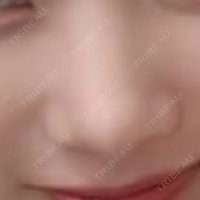 ボトックス（エラ・小顔） TCB東京中央美容外科 新宿三丁目院 BEFORE メイン用