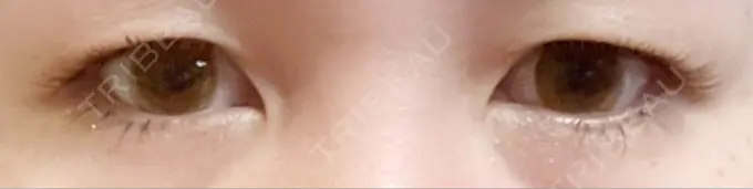 二重埋没 / 上まぶたの脂肪取り 恵聖会クリニック 梅田院 BEFORE メイン用