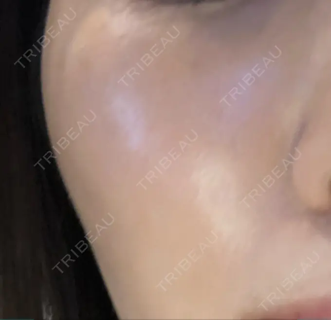 水光注射（ハリ・美肌） プチパーティー医院 BEFORE メイン用