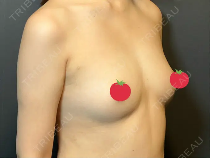 豊胸（シリコンバッグ） / ワキ汗治療（ボトックス） MYCLI【マイクリ】東京・恵比寿院 BEFORE メイン用