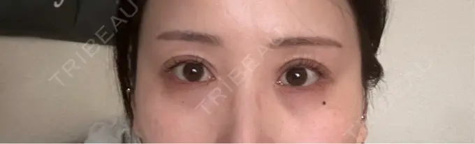 目尻靭帯移動 アネシス美容クリニック BEFORE メイン用