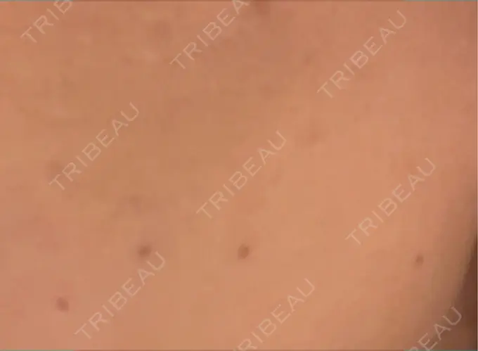 ほくろ・いぼ除去レーザー（肌） 白金ビークリニック 本院 BEFORE メイン用