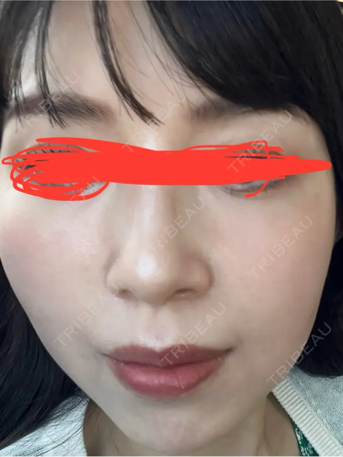 イオン導入 ルラ美容クリニック 名古屋本院 BEFORE メイン用