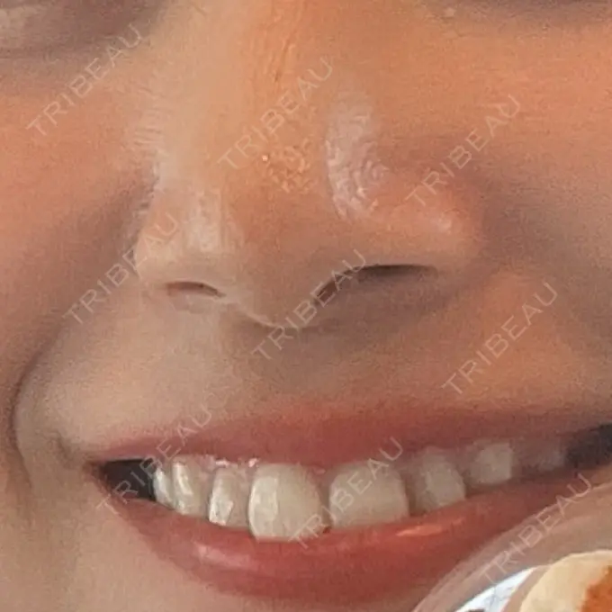 その他（鼻） ROOTS Clinic BEFORE メイン用