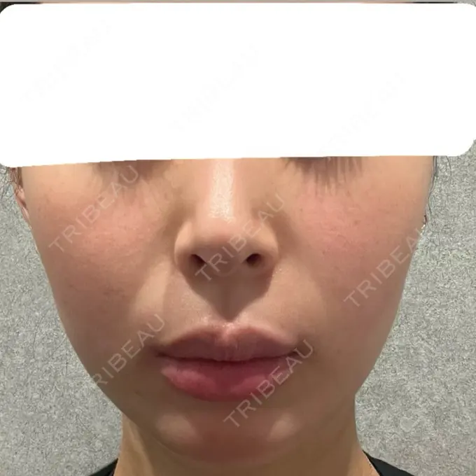 肌ヒアルロン酸注入（たるみ・シワ改善） / 水光注射（ハリ・美肌） シェリークリニック 福岡院 BEFORE メイン用