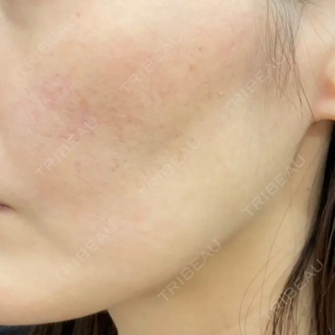 その他（肌） / ポテンツァ 東京美容外科 京都河原町院 BEFORE メイン用