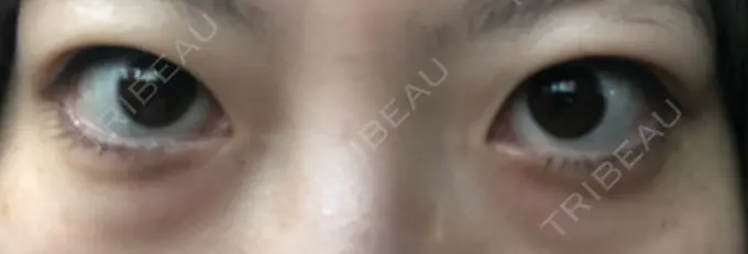 二重埋没 共立美容外科 大宮院 BEFORE メイン用