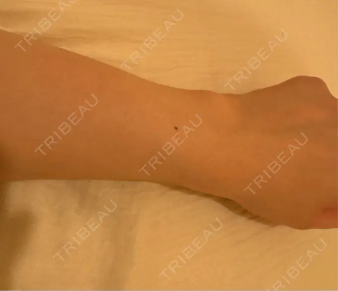 医療脱毛（全身） ジュエルクリニック 恵比寿院 BEFORE メイン用