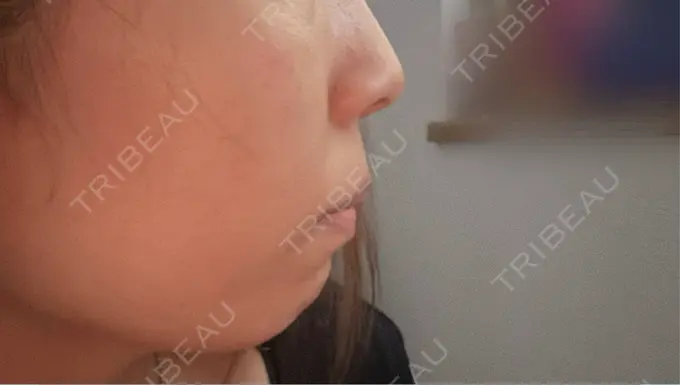 ヒアルロン酸注入（鼻） / ボトックス（あご） / ヒアルロン酸注入（唇） / ヒアルロン酸注入（鼻翼基部） ルラ美容クリニック 池袋院 BEFORE メイン用