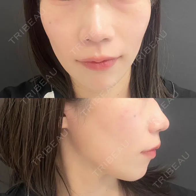 ボトックス（あご） / ヒアルロン酸注入（頬） / ヒアルロン酸注入（鼻翼基部） ルラ美容クリニック 池袋院 BEFORE メイン用