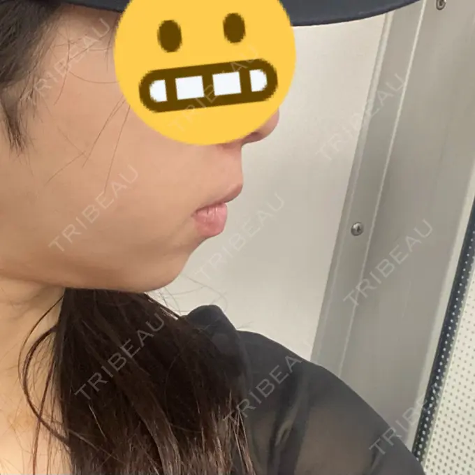 ヒアルロン酸注入（あご） Otus Clinic 【オータスクリニック】 BEFORE メイン用