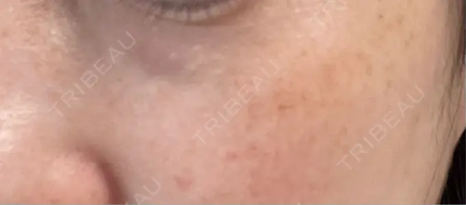 シミ取りレーザー Mavie Beauty Clinic （マヴィービューティークリニック） BEFORE メイン用