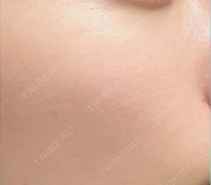 ピーリング（ハリ・ツヤ） 新宿美容外科クリニック 新宿院 BEFORE メイン用