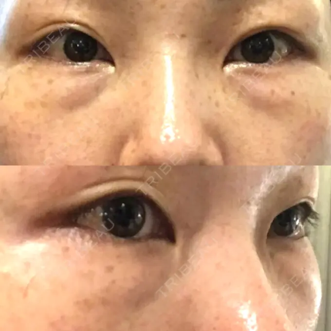 下まぶたたるみ取り / 下まぶたの脂肪取り 韓国ST美容整形外科 BEFORE メイン用