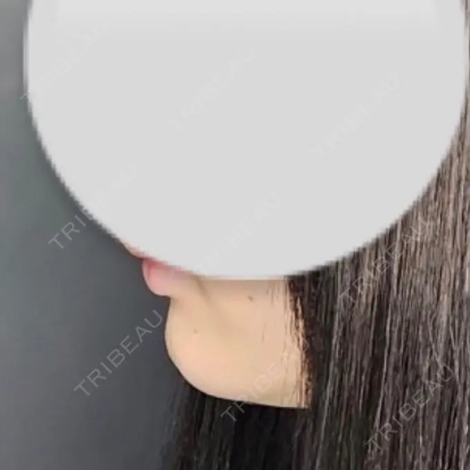 ボトックス（あご） / ヒアルロン酸注入（あご） Tokyo Tensei Clinic 新宿院 BEFORE メイン用