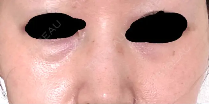 クマ治療 / 下まぶたの脂肪取り / 脂肪注入（目の下） 吉井クリニック BEFORE メイン用